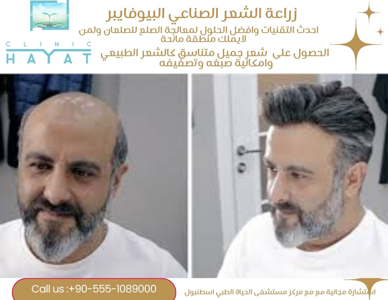 زراعة الشعر الصناعي البيوفايبر