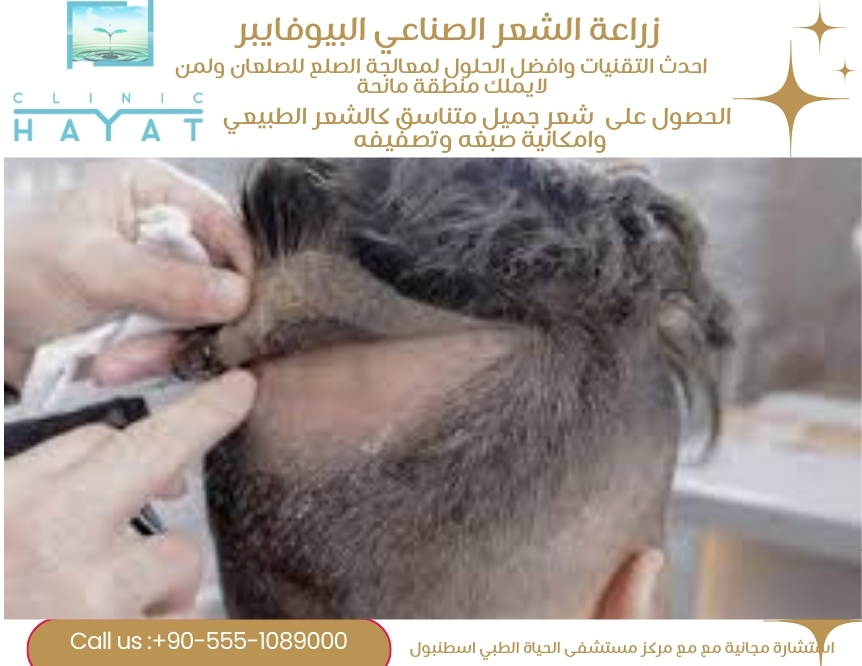 زراعة الشعر الصناعي البيوفايبر 