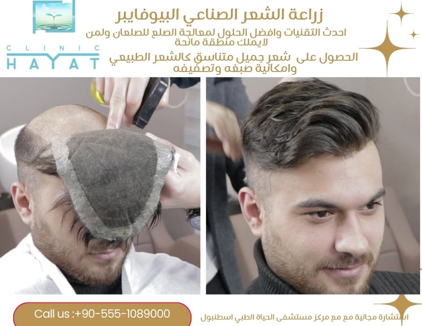 زراعة الشعر الصناعي البيوفايبر 