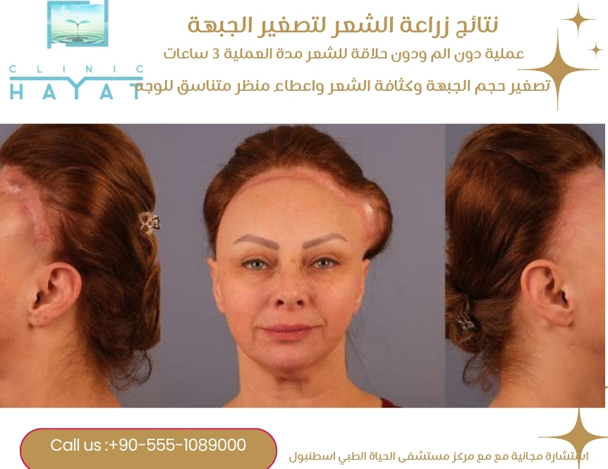 زراعة الشعر لتصغير الجبهة