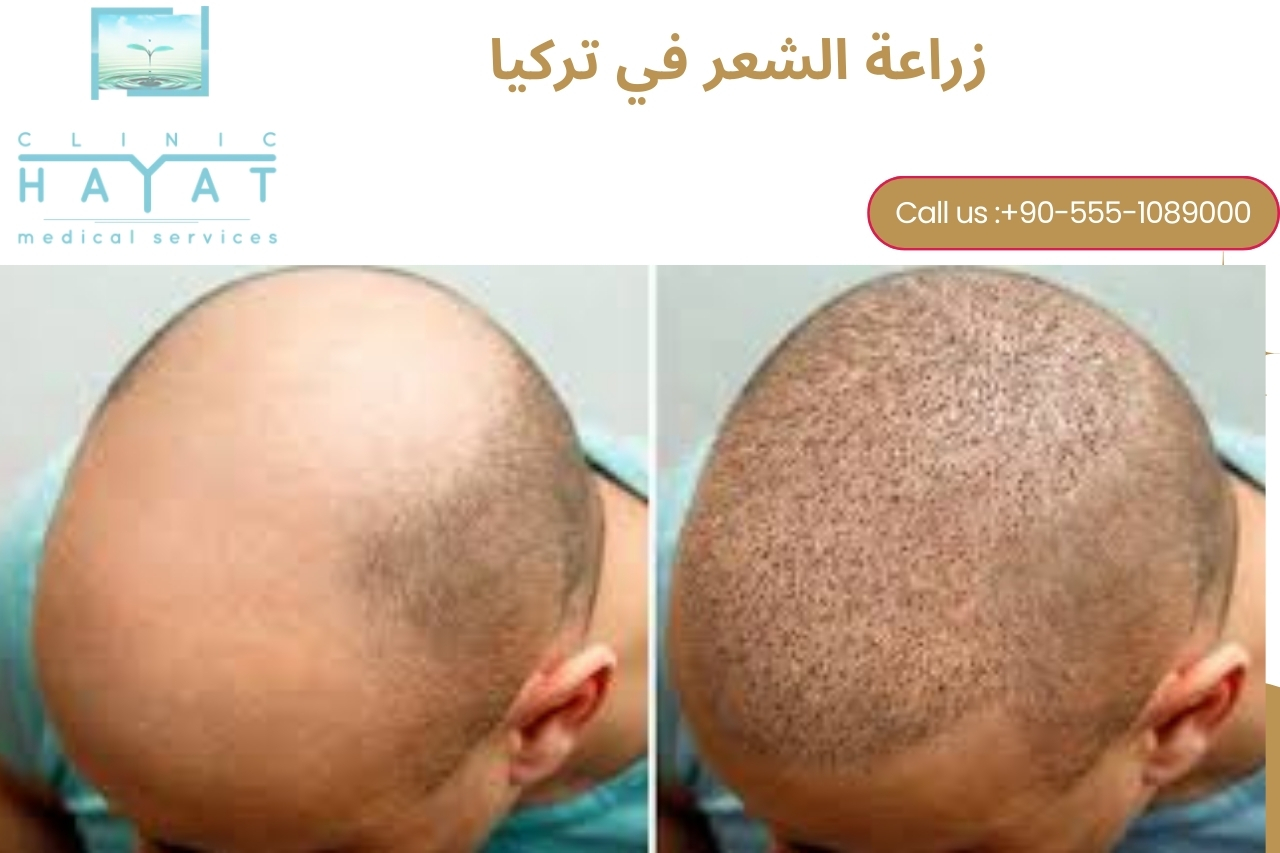 تكلفة زراعة الشعر في تركيا 2025