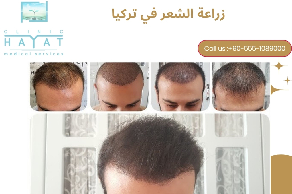 تكلفة زراعة الشعر في تركيا 2025