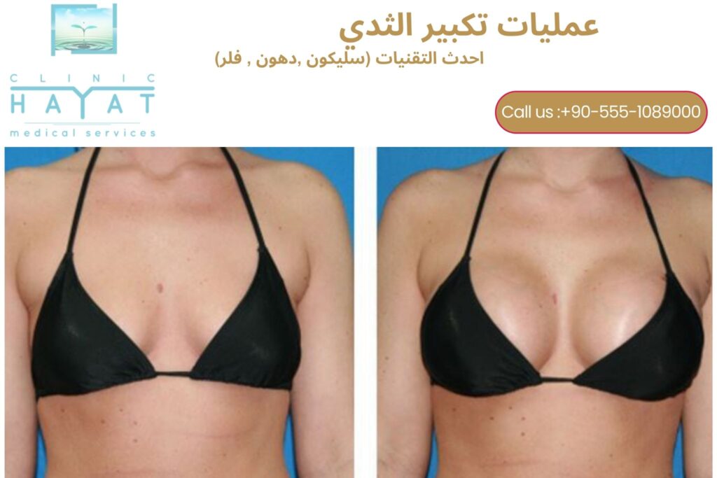 تكبير الثدي في تركيا