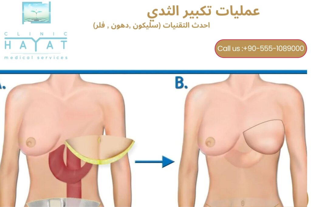 تكبير الثدي في تركيا 2026 | أفضل تقنيات وأفضل الأطباء