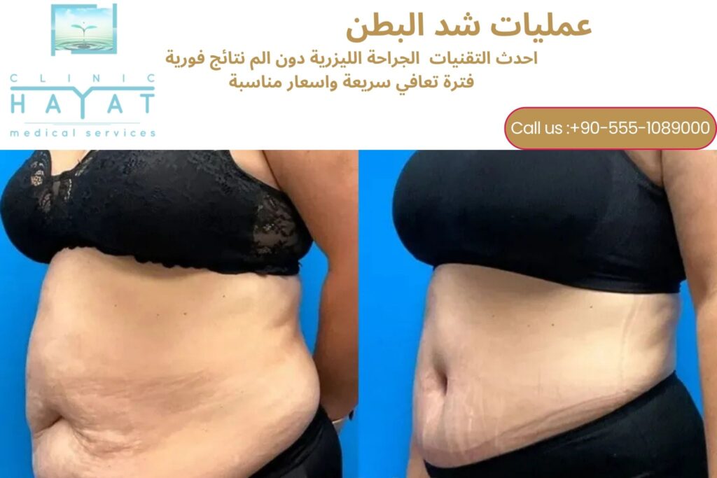 شد البطن في تركيا 2026 | أحدث تقنيات الحصول على بطن مشدود ومتناسق