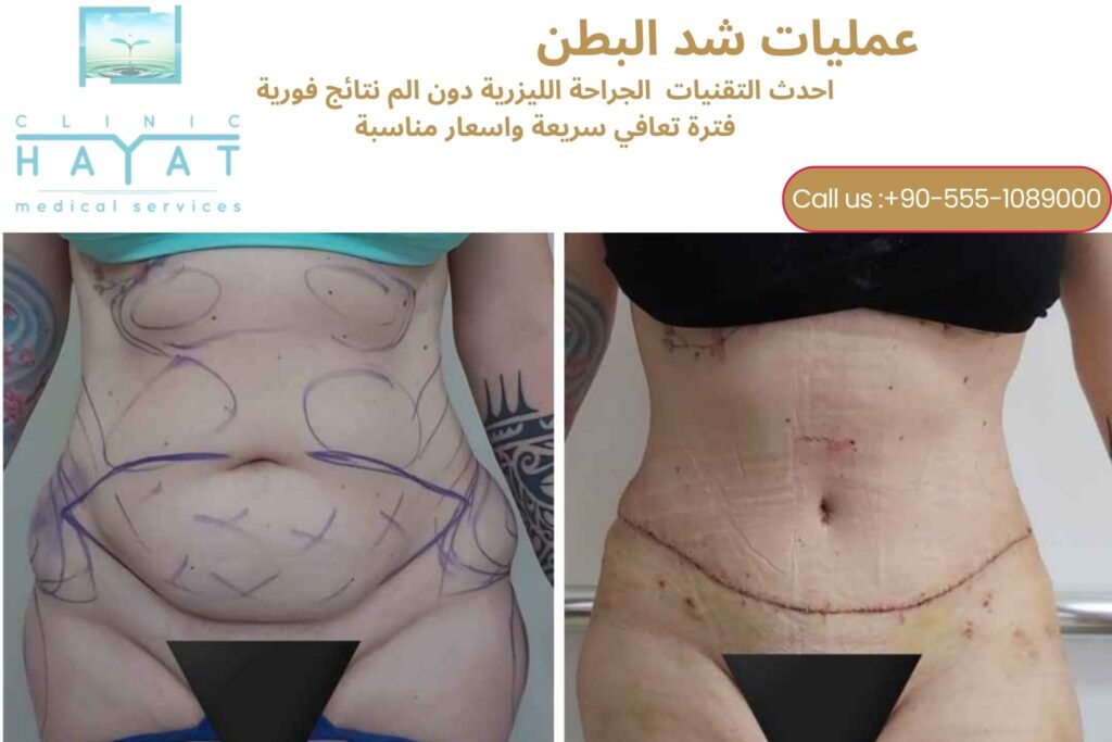 شد البطن في تركيا 2026