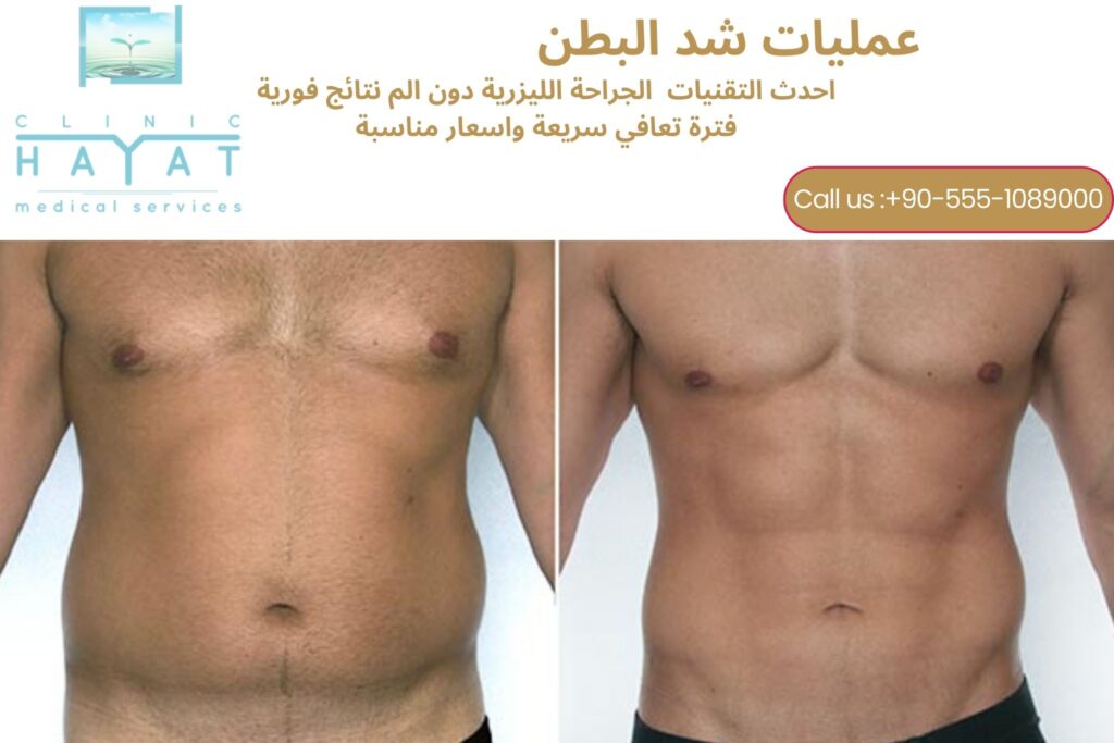 شد البطن في تركيا