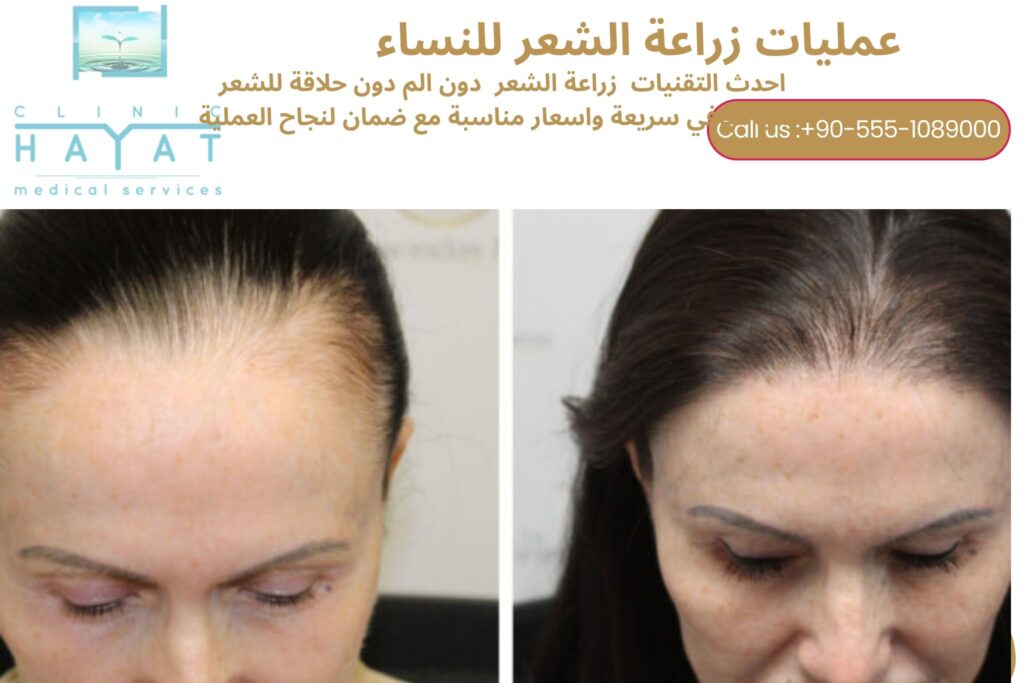 زراعة الشعر للنساء في تركيا 