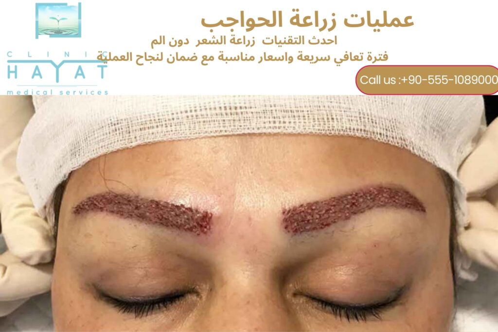 زراعة الحواجب في تركيا 2026 | أفضل تقنيات الحصول على حواجب كثيفة وطبيعية