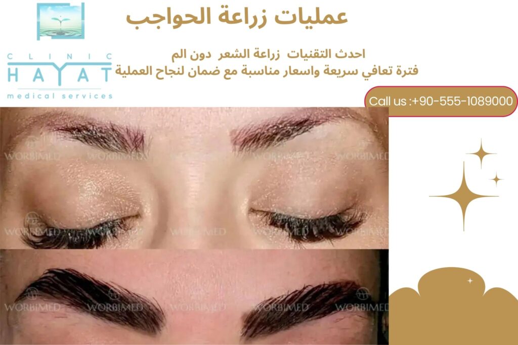 زراعة الحواجب في تركيا 2026 | أفضل تقنيات الحصول على حواجب كثيفة وطبيعية