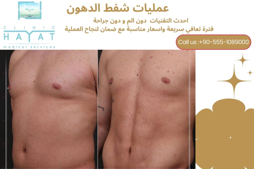 عمليات شفط الدهون في تركيا