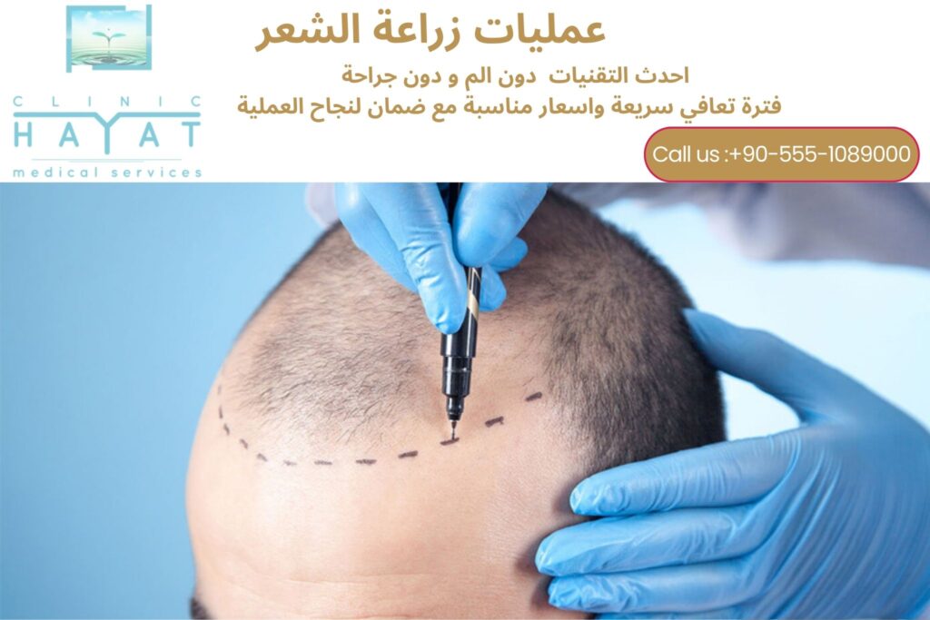 زراعة الشعر في تركيا 2026: الدليل الشامل للنتائج المضمونة والتقنيات والأسعار وأفضل العيادات