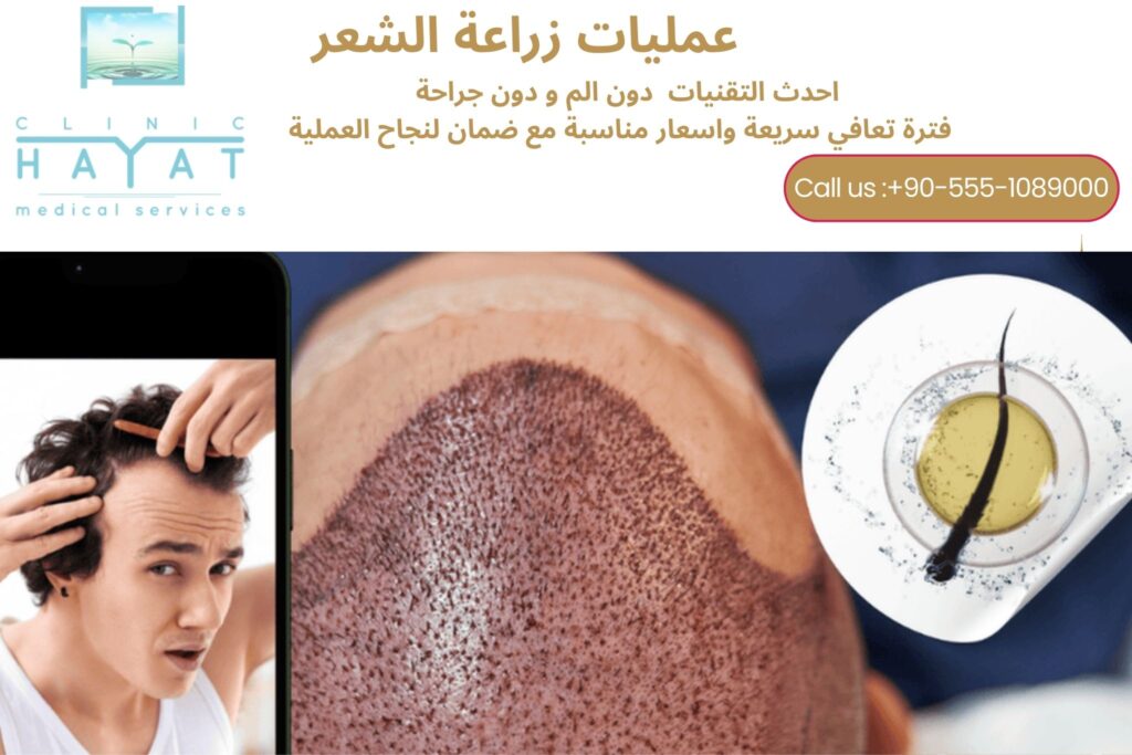 زراعة الشعر في تركيا 2026