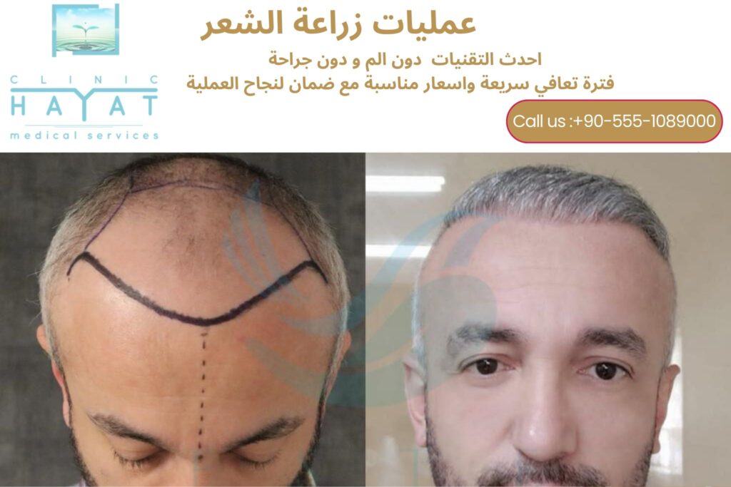 تجارب زراعة الشعر في تركيا