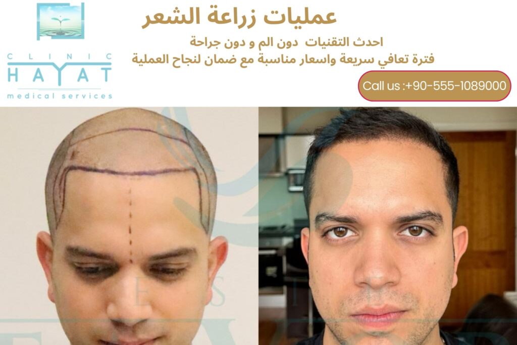 زراعة الشعر في تركيا