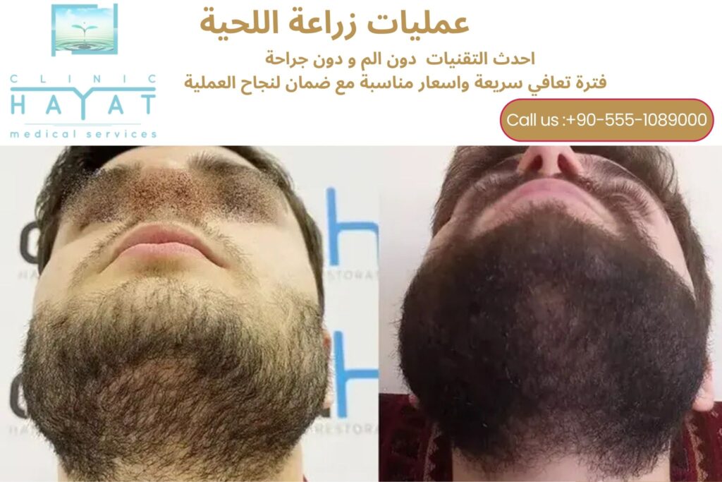 زراعة اللحية في تركيا 2026