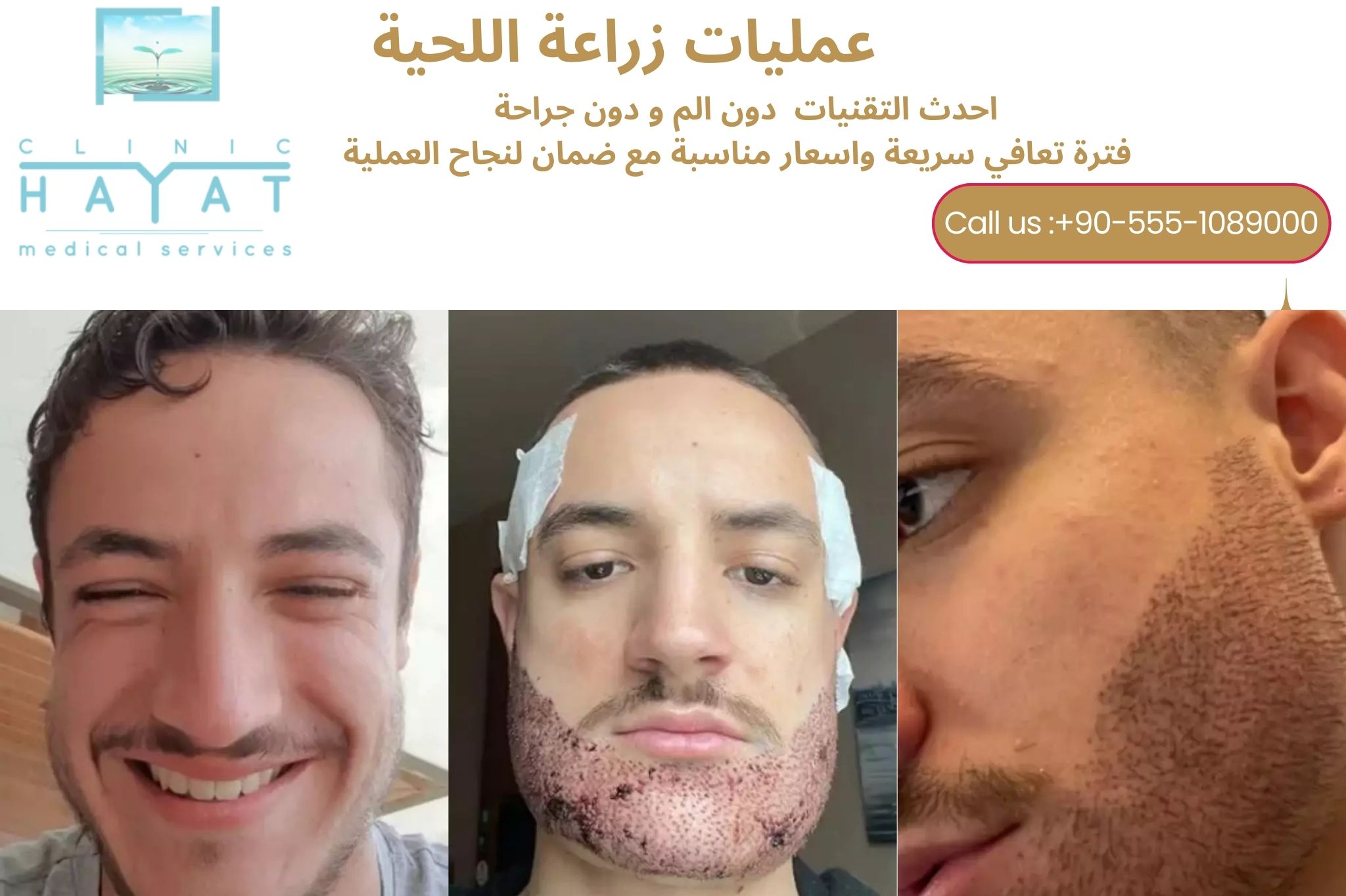 زراعة اللحية في تركيا