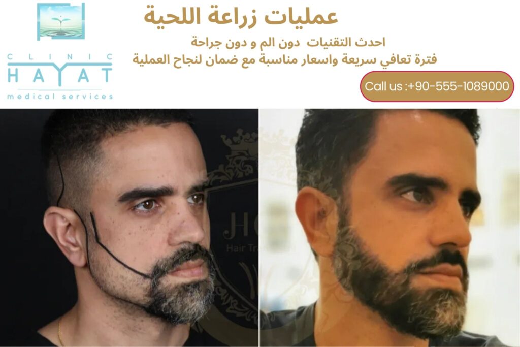 نتائج زراعة اللحية في تركيا