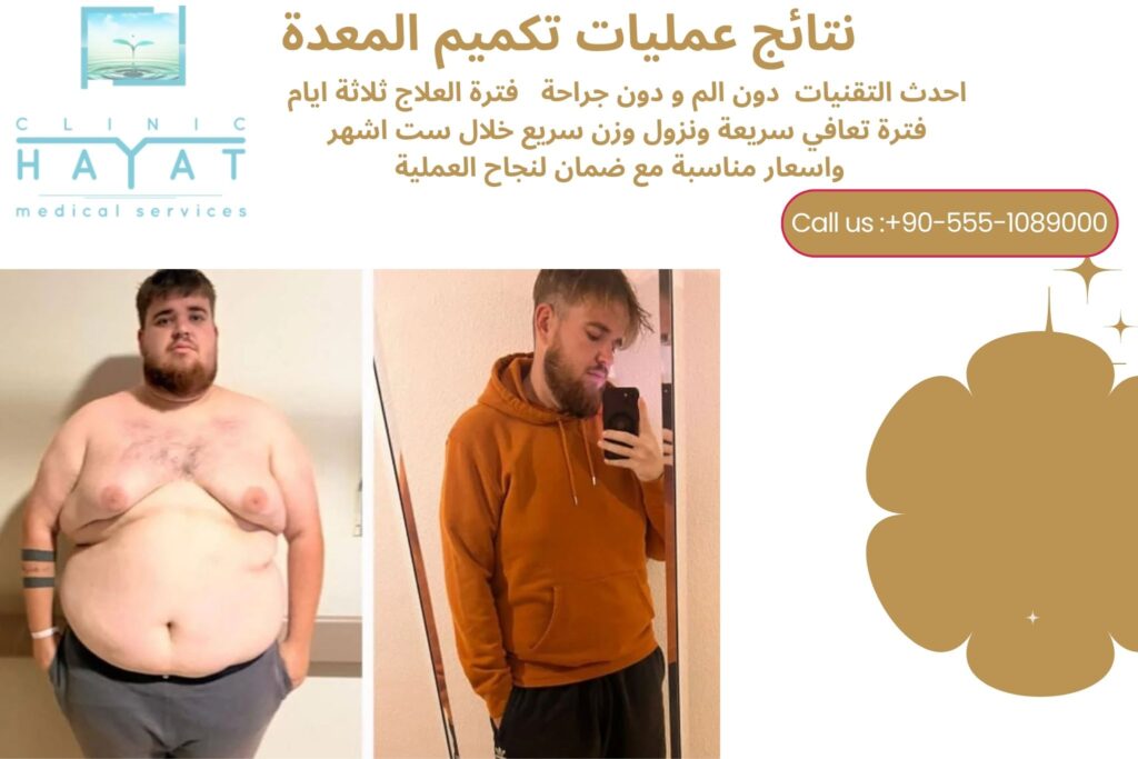 تجارب تكميم المعدة في تركيا