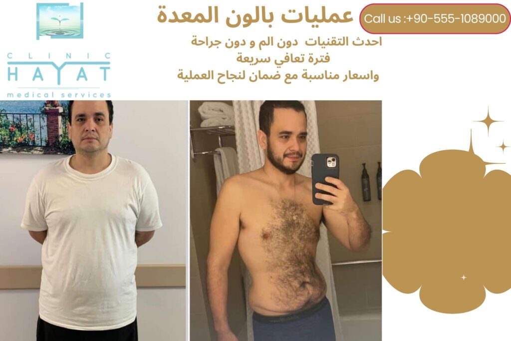 عملية بالون المعدة في تركيا 2026