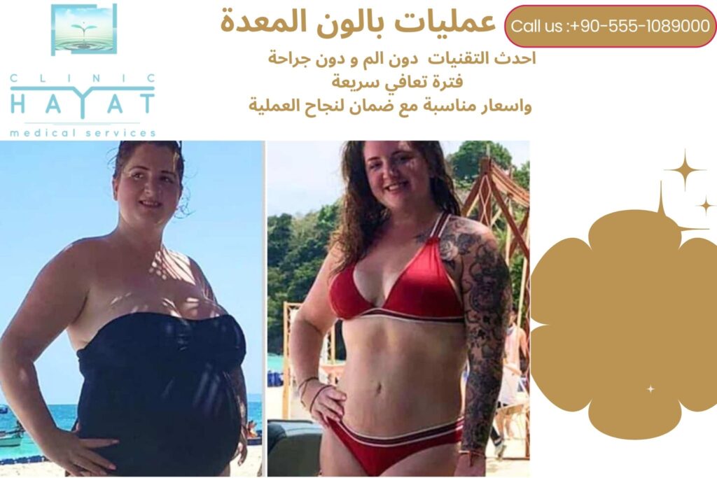 نتائج عملية بالون المعدة في تركيا