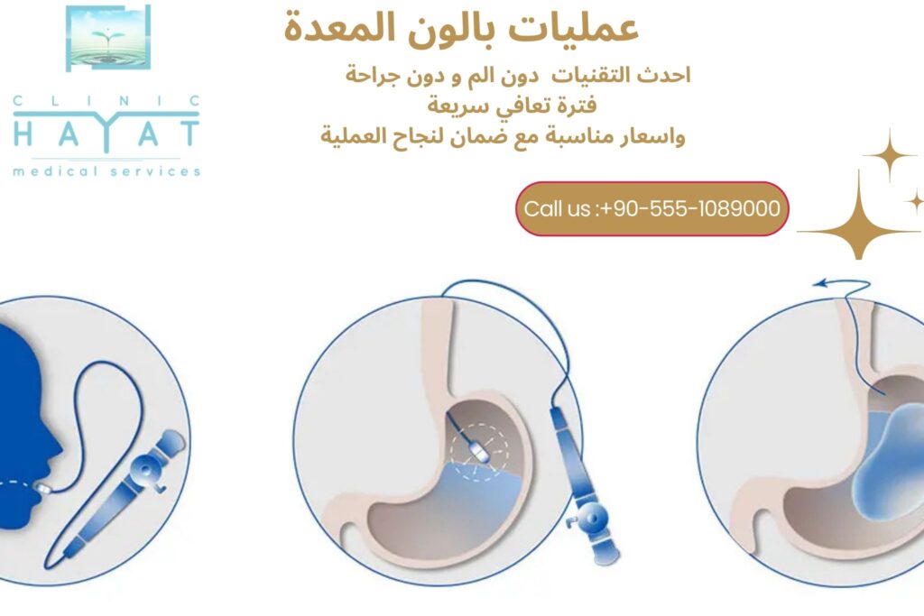 عملية بالون المعدة في تركيا 2026