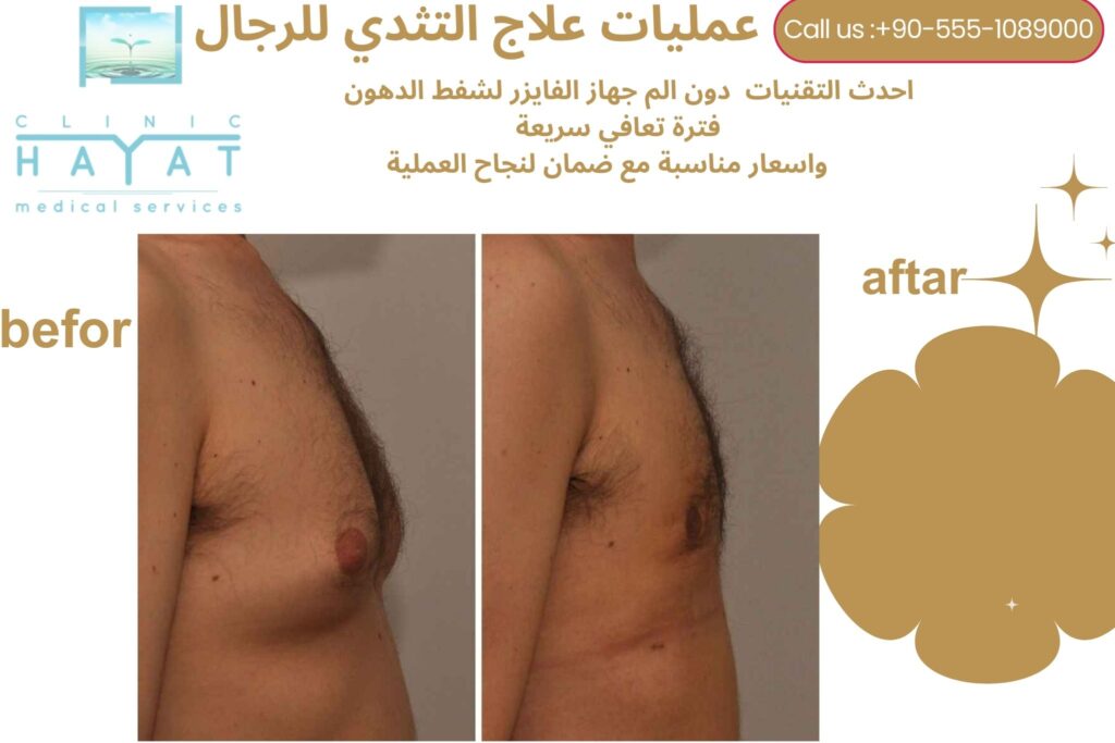 نتائج عمليات تصغير الثدي للرجال في تركيا