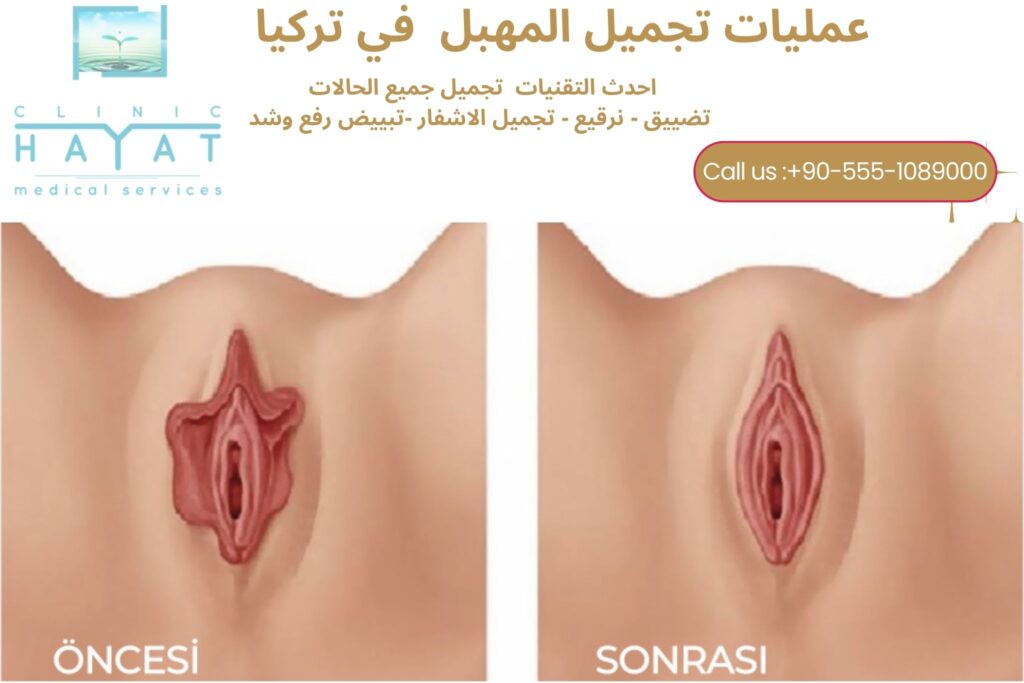 تجميل المهبل في تركيا 2026