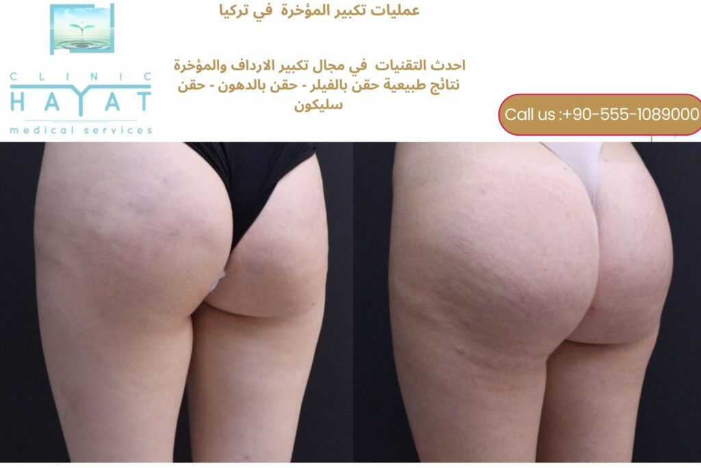 تكبير المؤخرة في تركيا 2026