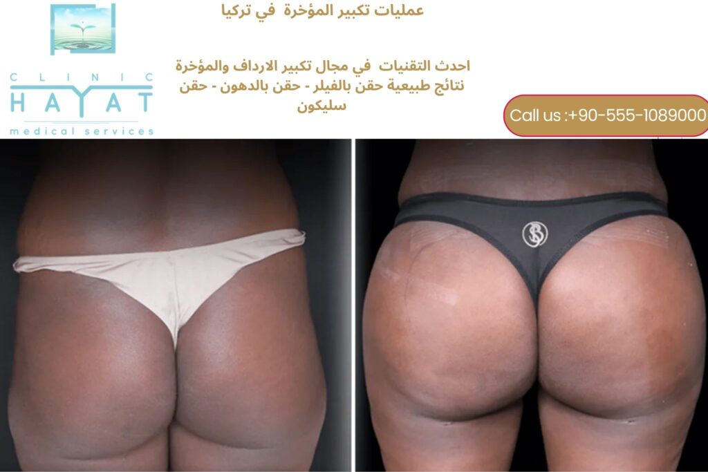 تكبير الارداف في تركيا