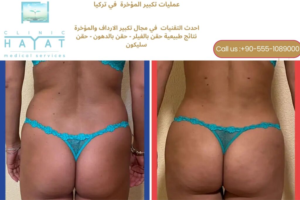 تكبير المؤخرة في تركيا