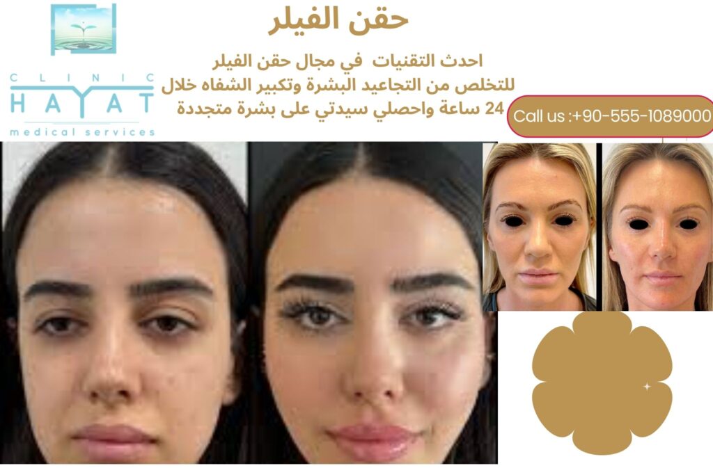 حقن ابر الفيلر في تركيا