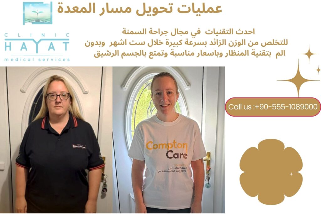 تحويل مسار المعدة في تركيا