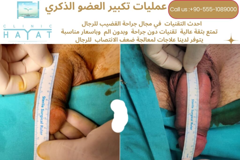 تكبير القضيب في تركيا 2026