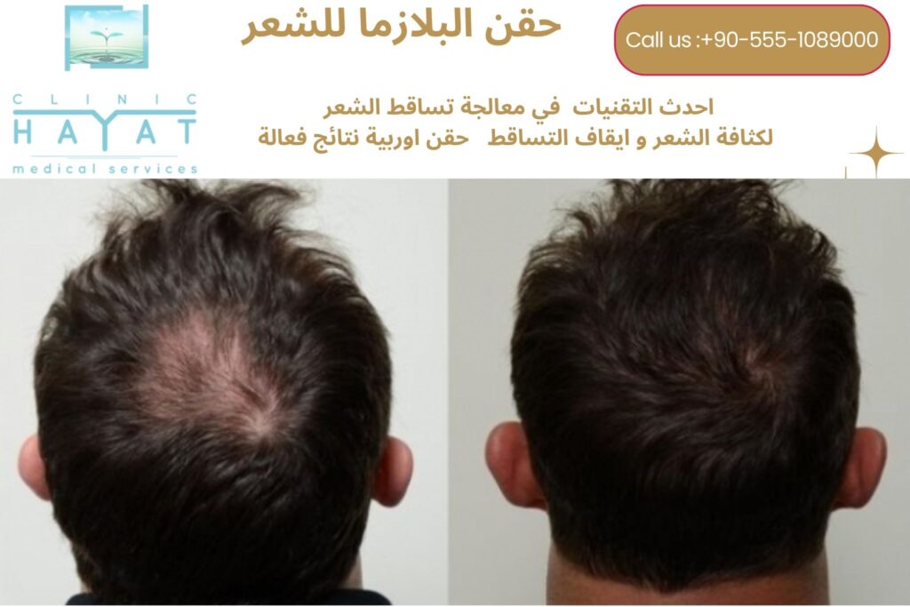 نتائج حقن البلازما للشعر في تركيا