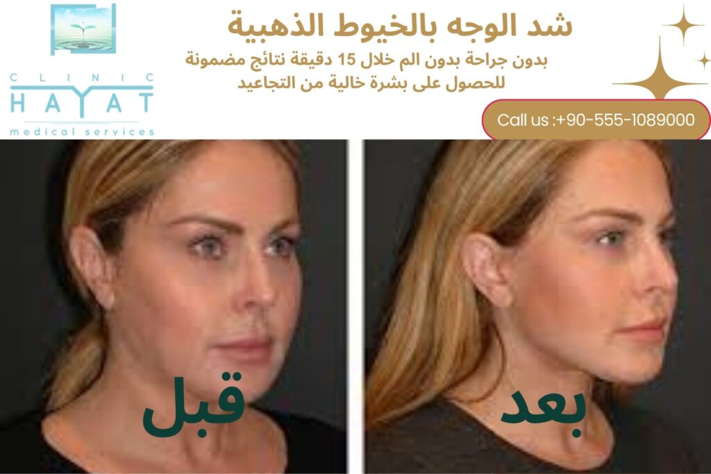 شد الوجه بالخيوط الذهبية في تركيا 2026: أحدث تقنية لرفع وشد البشرة بدون جراحة ونتائج فورية