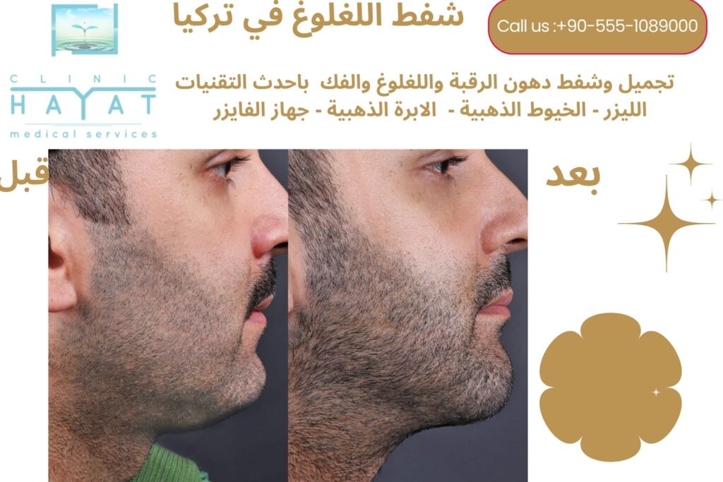 شفط اللغلوغ في تركيا 2026