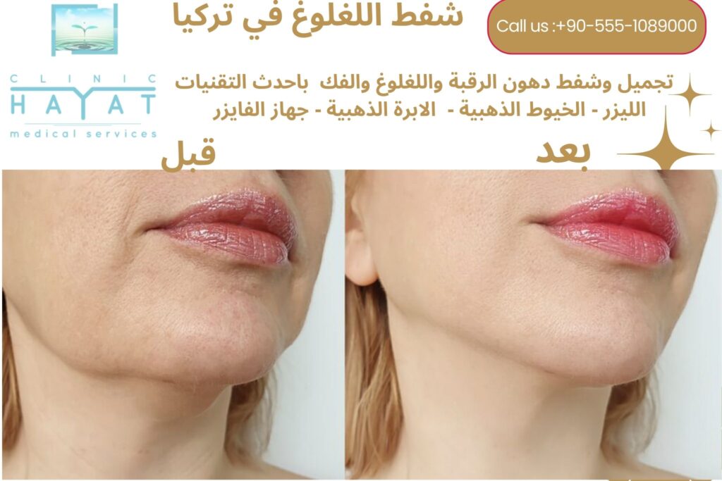 صور قبل وبعد شفط دهون الرقبة في تركيا