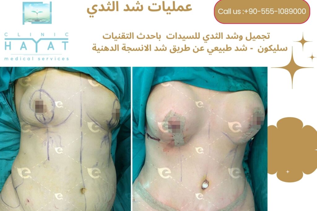 رفع الثدي في تركيا