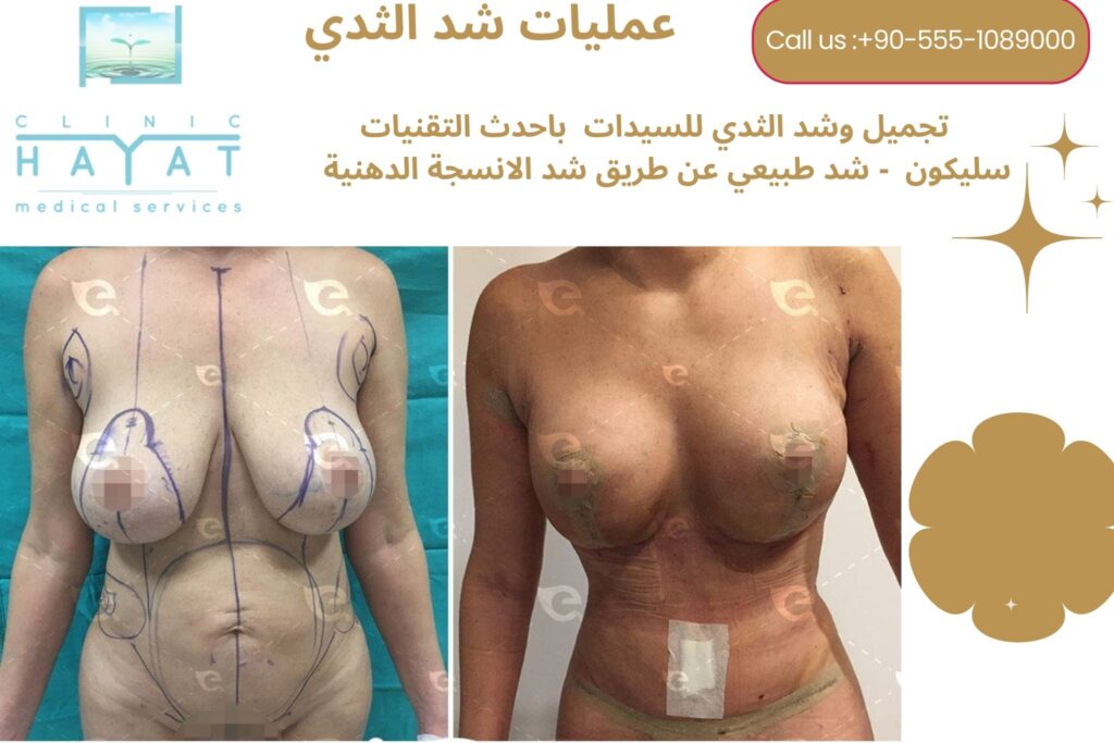 شد الثدي في تركيا 2026